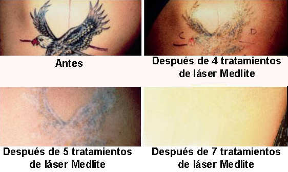 borrar tatuaje brazo. tatuajes de dragonfly. borrar tatuajes mexico.