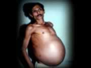 Sanju Bhagat fetus feto fetu