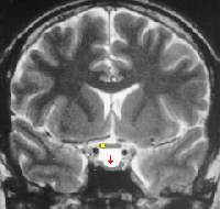 silla-turca-hipofisis-cerebro-radiografia
