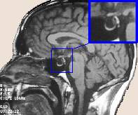 silla-turca-hipofisis-cerebro