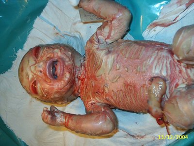 Ictiosis arlequin harlequin bebe