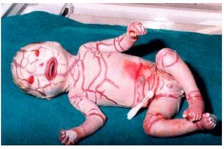 Ictiosis arlequin harlequin feto
