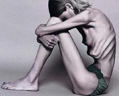 anorexia salud delgadez