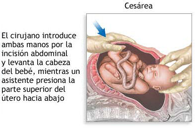 parto abdominal cesarea
